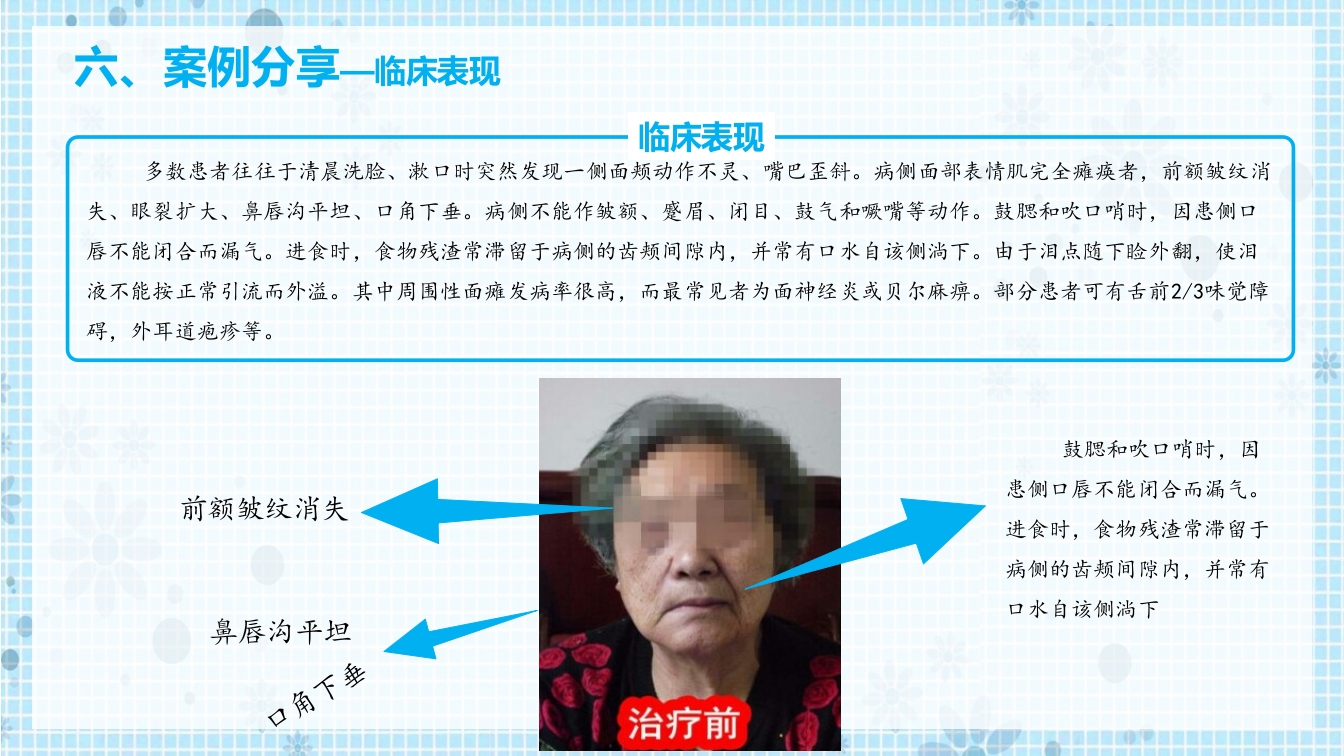 面瘫病人的护理PPT课件17