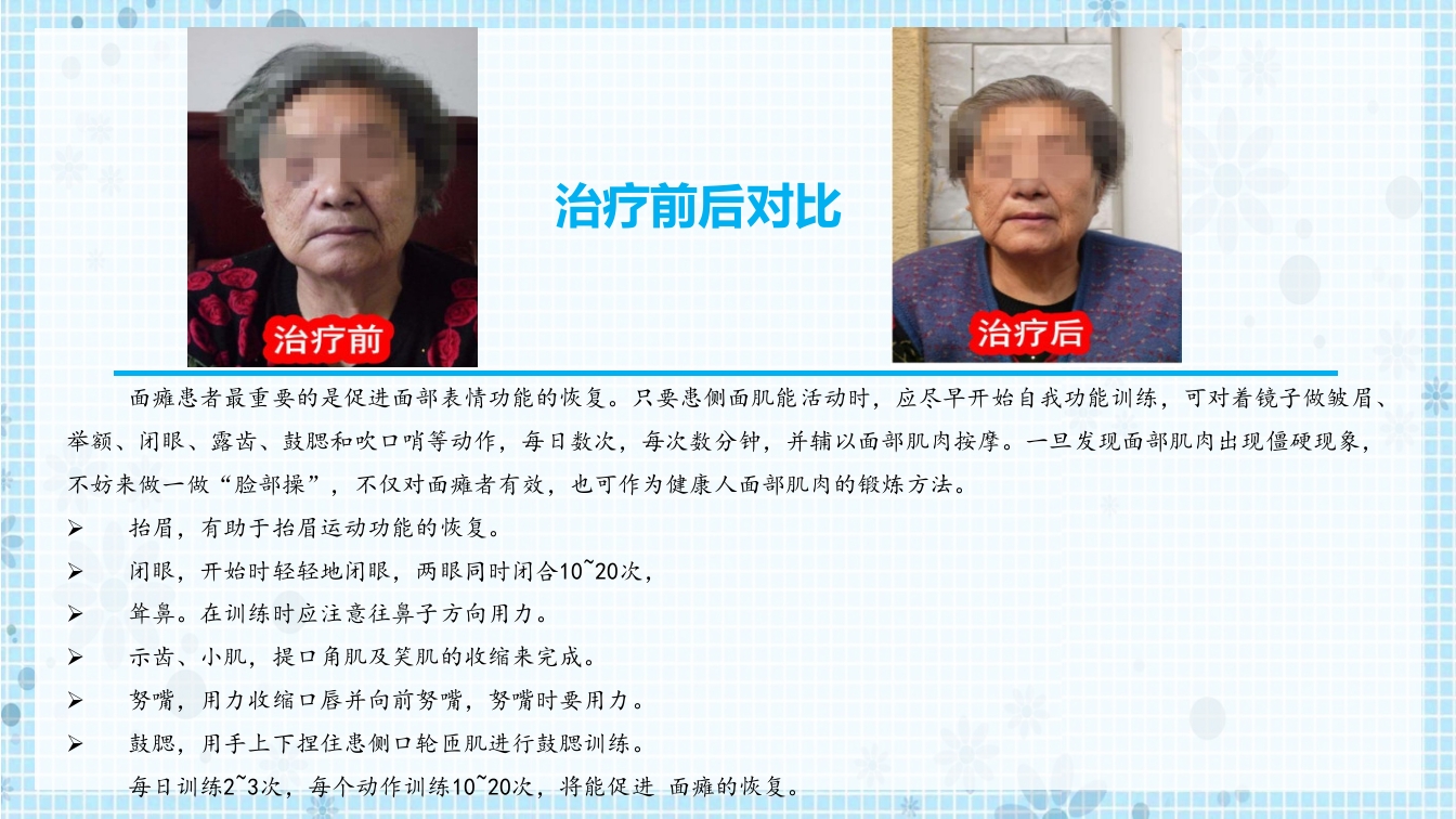 面瘫病人的护理PPT课件20