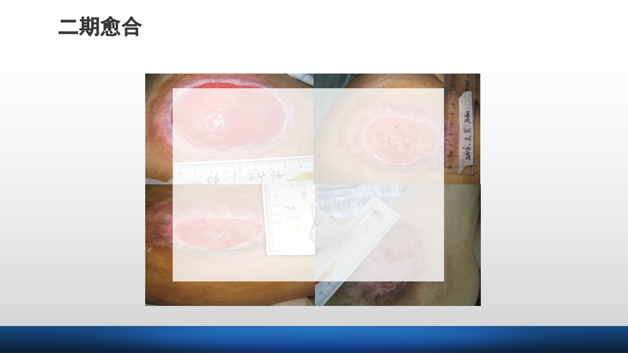 外科伤口护理技术PPT课件16