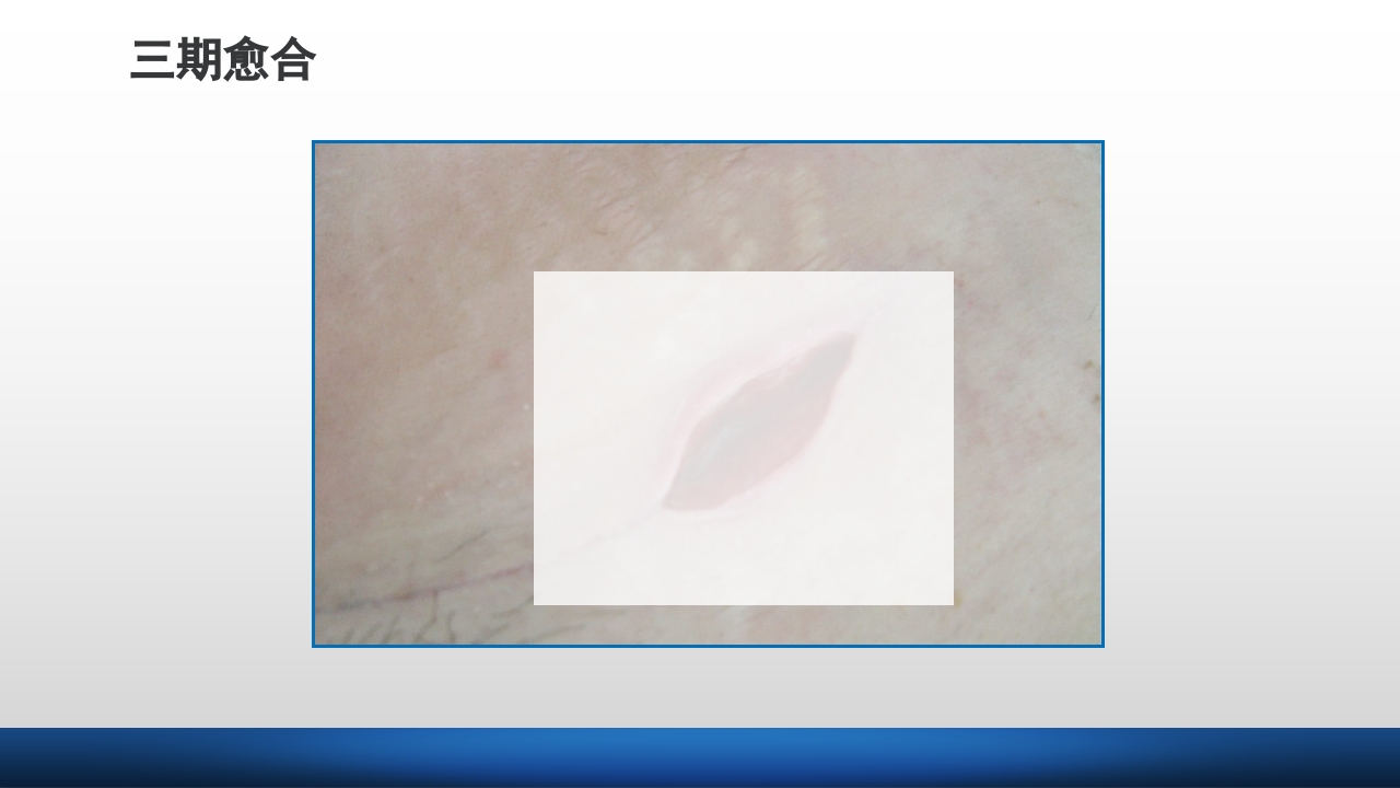 外科伤口护理技术PPT课件18