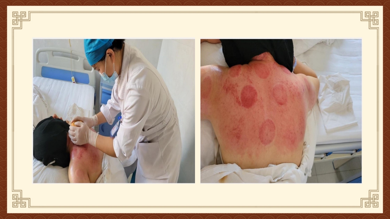 火龙罐综合灸PPT课件下载39