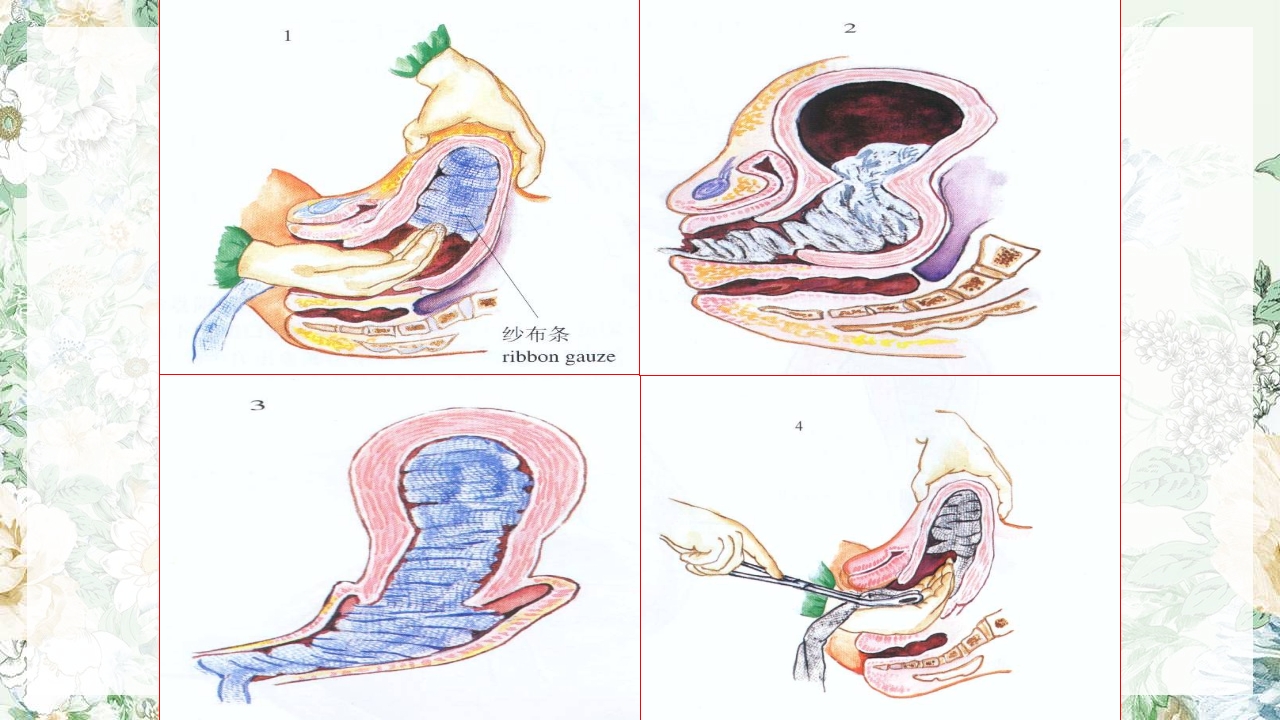 (妇产科)产后出血护理查房PPT课件26