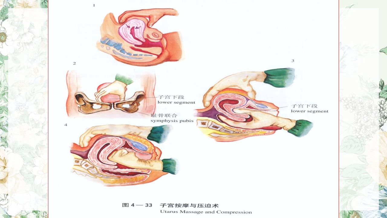 (妇产科)产后出血护理查房PPT课件27