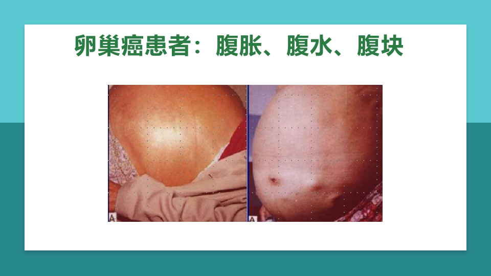 卵巢肿瘤护理查房卵巢癌护理查房PPT课件11