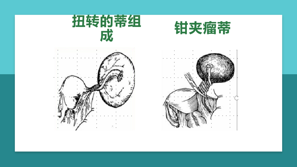 卵巢肿瘤护理查房卵巢癌护理查房PPT课件14