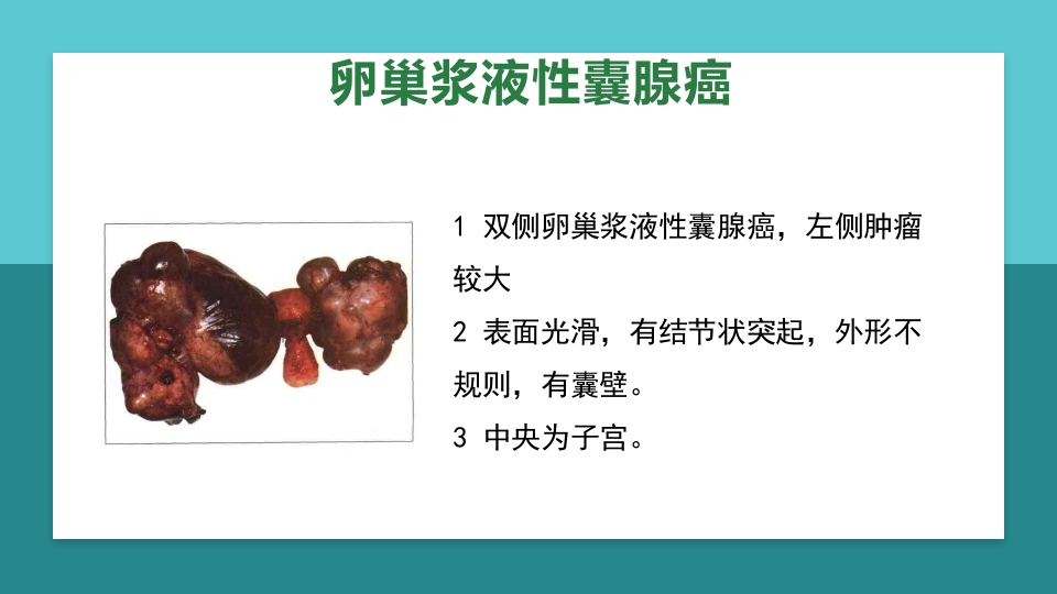 卵巢肿瘤护理查房卵巢癌护理查房PPT课件38