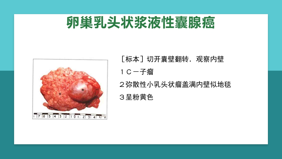 卵巢肿瘤护理查房卵巢癌护理查房PPT课件39