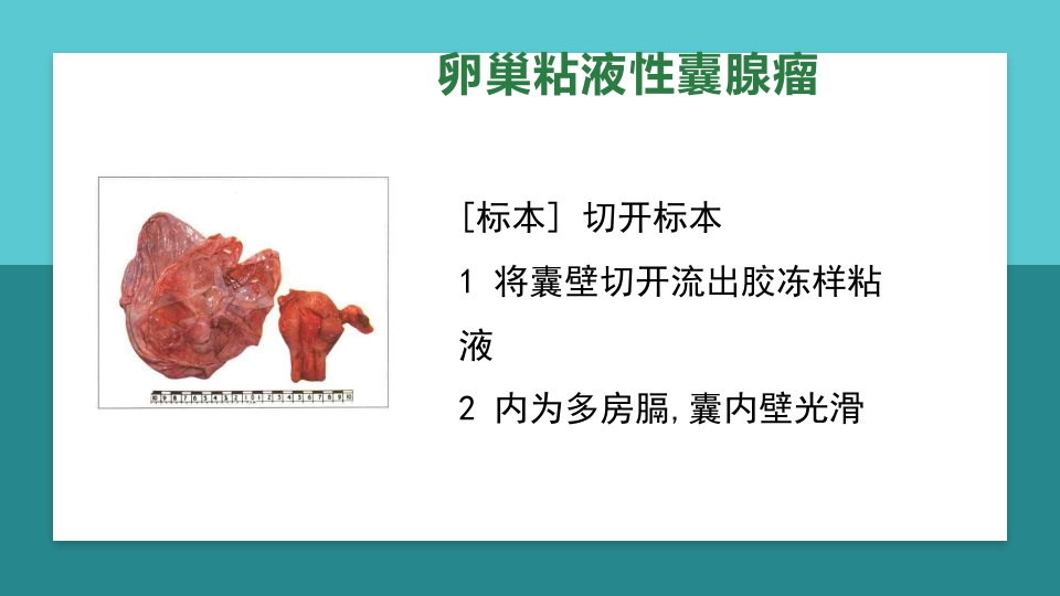卵巢肿瘤护理查房卵巢癌护理查房PPT课件42