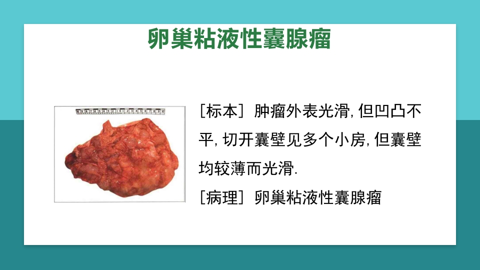 卵巢肿瘤护理查房卵巢癌护理查房PPT课件43