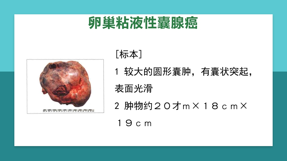 卵巢肿瘤护理查房卵巢癌护理查房PPT课件46