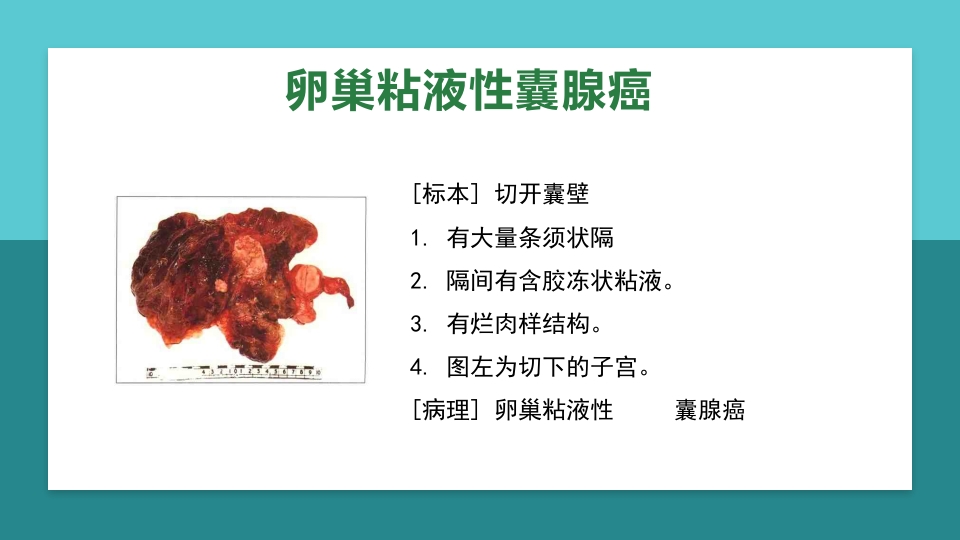 卵巢肿瘤护理查房卵巢癌护理查房PPT课件48