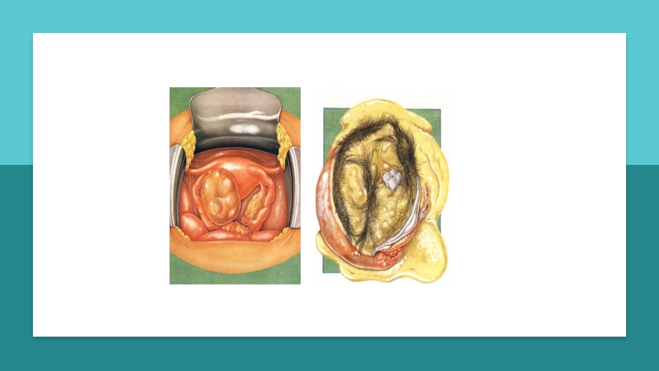 卵巢肿瘤护理查房卵巢癌护理查房PPT课件59