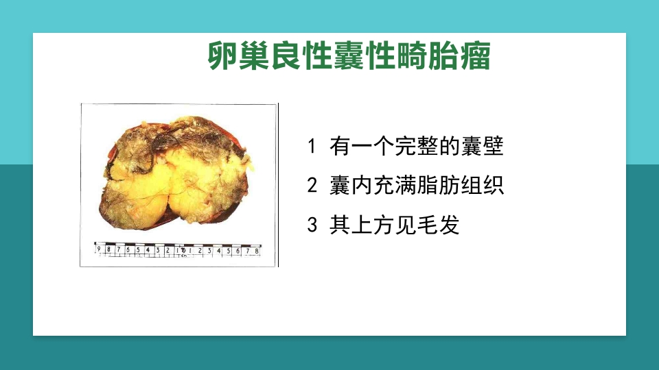 卵巢肿瘤护理查房卵巢癌护理查房PPT课件60