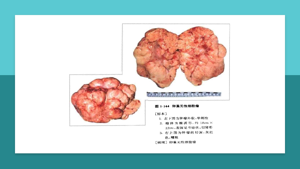 卵巢肿瘤护理查房卵巢癌护理查房PPT课件63