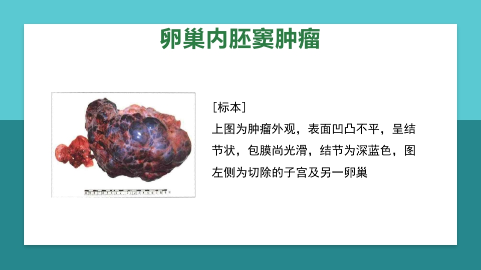 卵巢肿瘤护理查房卵巢癌护理查房PPT课件65