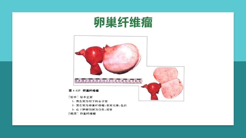 卵巢肿瘤护理查房卵巢癌护理查房PPT课件70