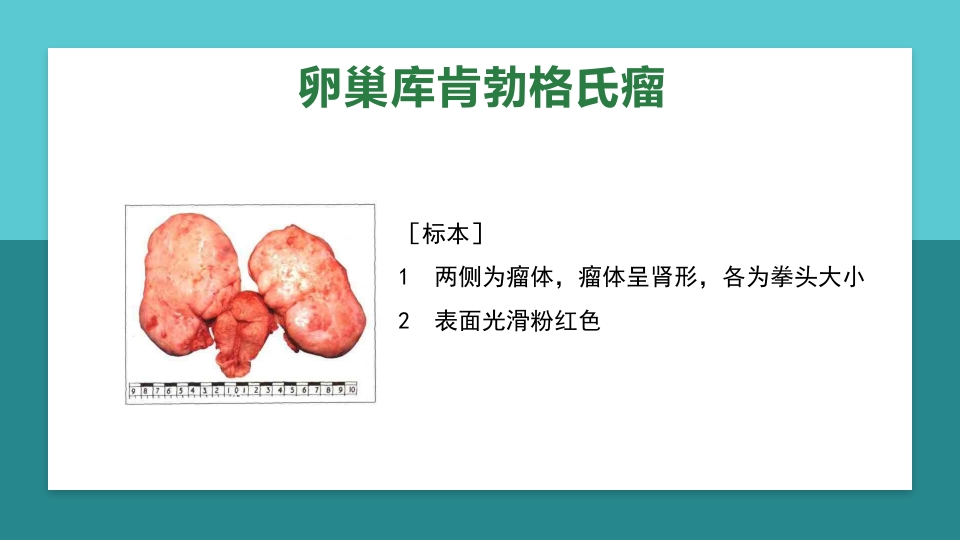 卵巢肿瘤护理查房卵巢癌护理查房PPT课件74