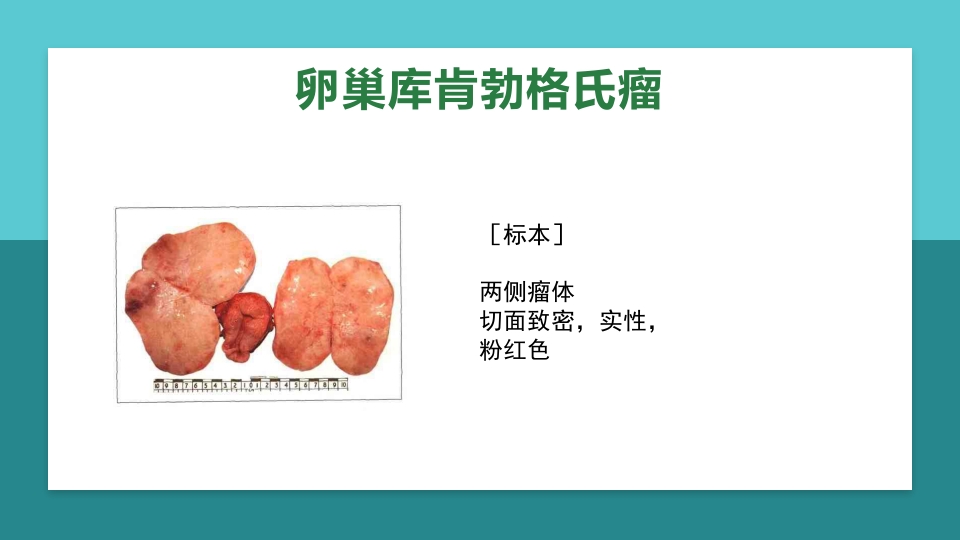 卵巢肿瘤护理查房卵巢癌护理查房PPT课件75