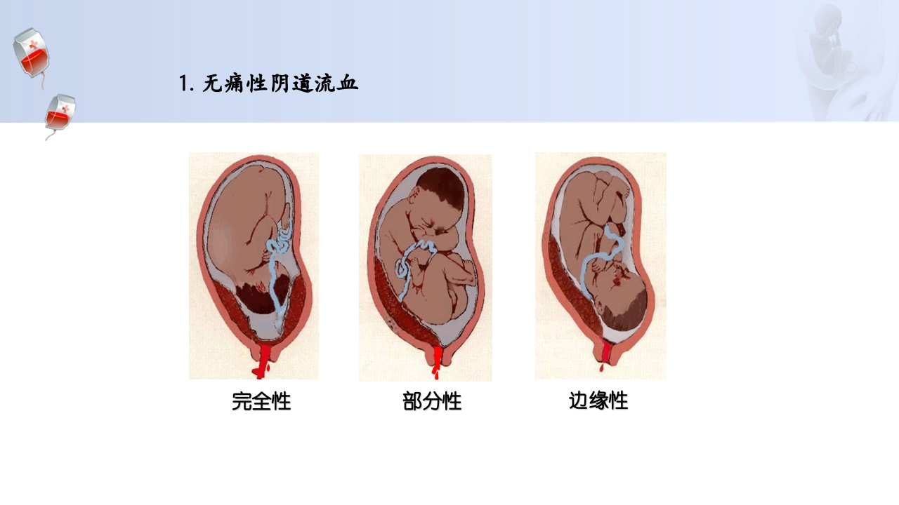 1例介入联合子宫全切救治产后大出血病人的病情讨论PPT13