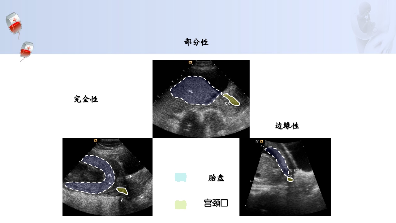 1例介入联合子宫全切救治产后大出血病人的病情讨论PPT20