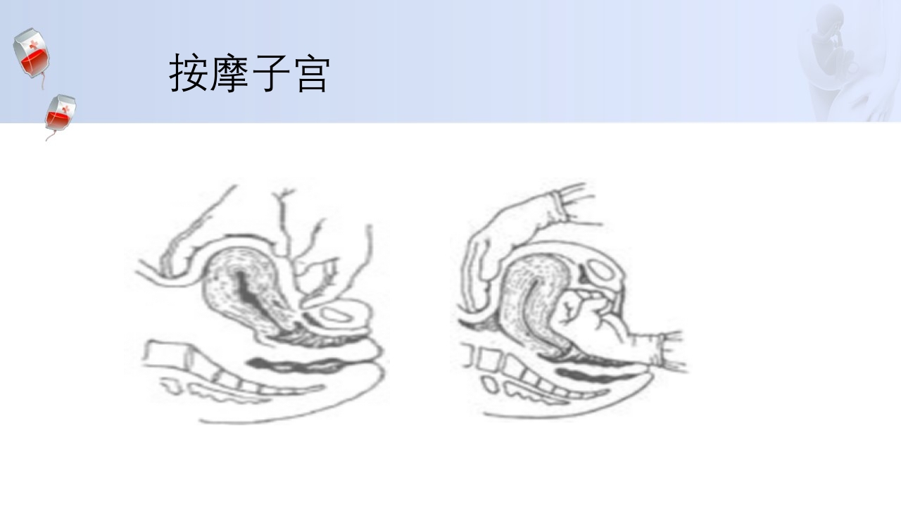 1例介入联合子宫全切救治产后大出血病人的病情讨论PPT33