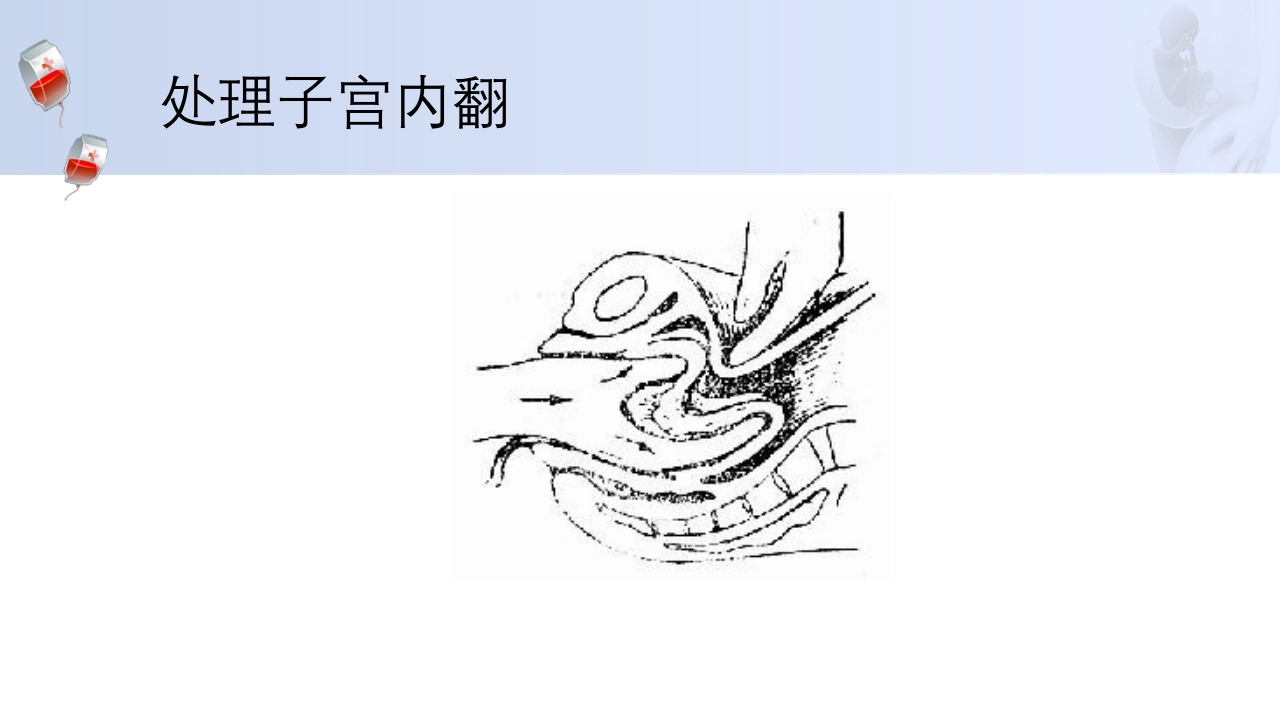 1例介入联合子宫全切救治产后大出血病人的病情讨论PPT35