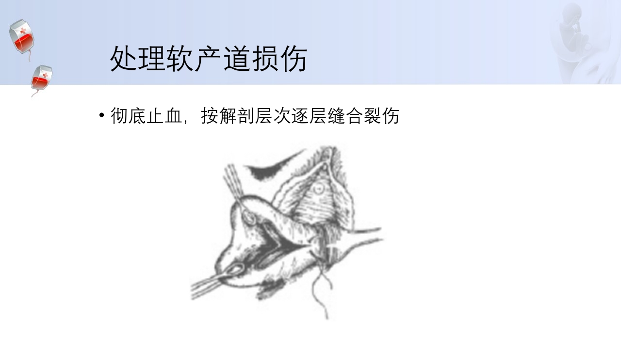 1例介入联合子宫全切救治产后大出血病人的病情讨论PPT36