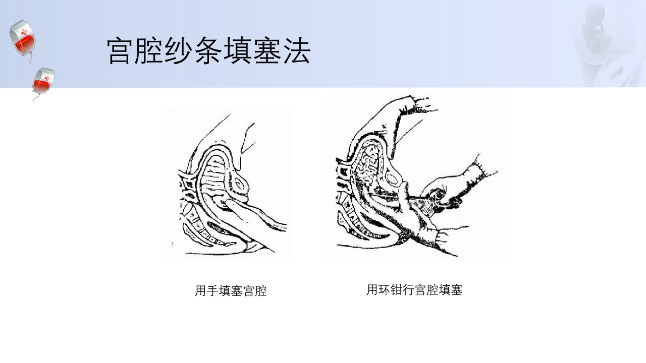 1例介入联合子宫全切救治产后大出血病人的病情讨论PPT38