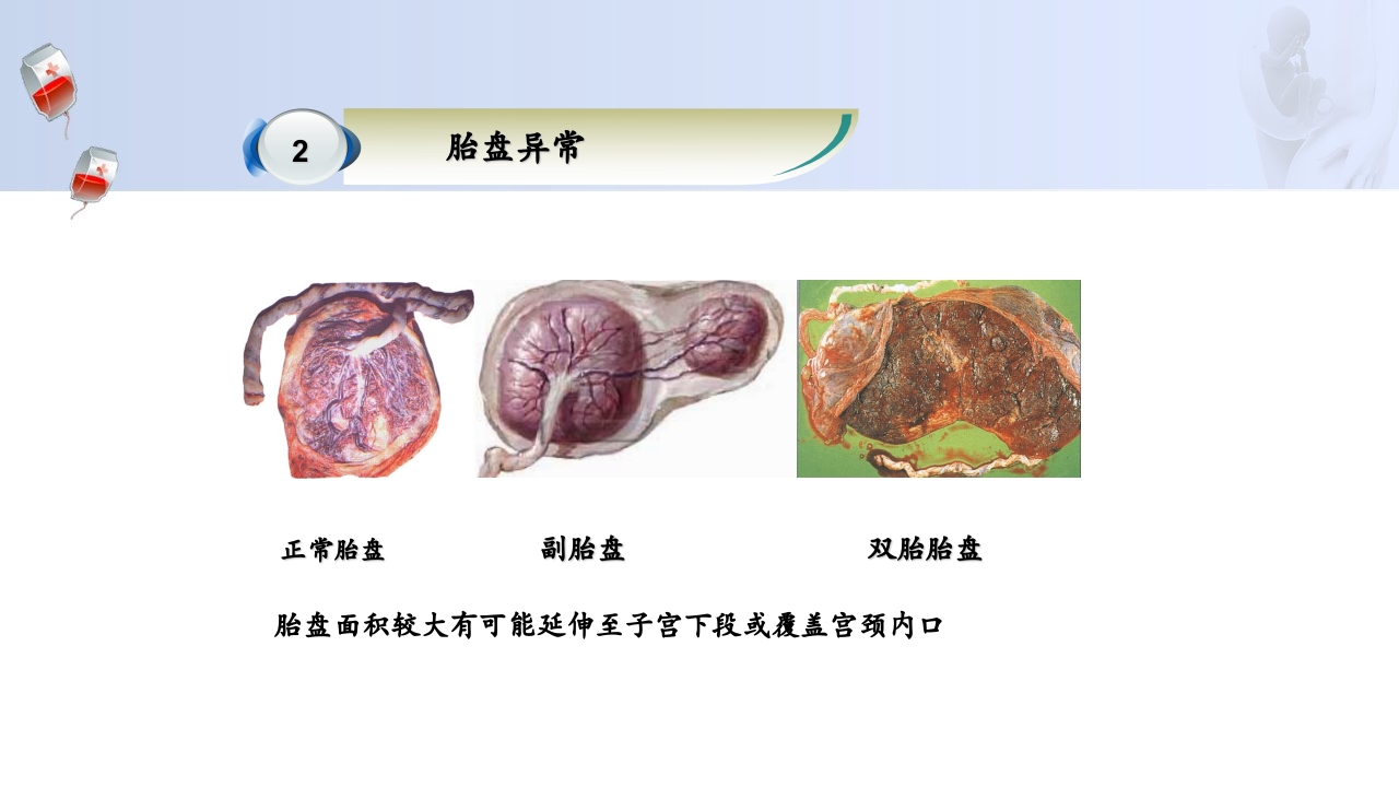 1例介入联合子宫全切救治产后大出血病人的病情讨论PPT42