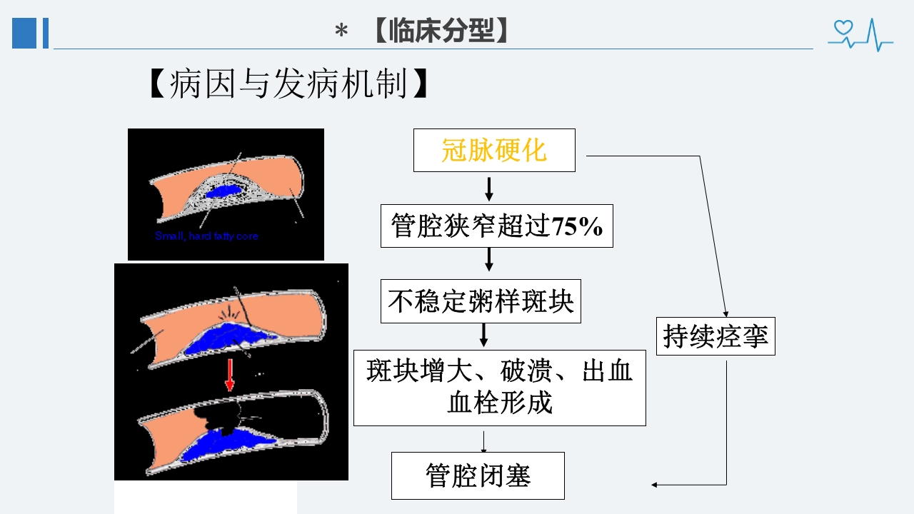 冠心病诊断治疗护理PPT课件19