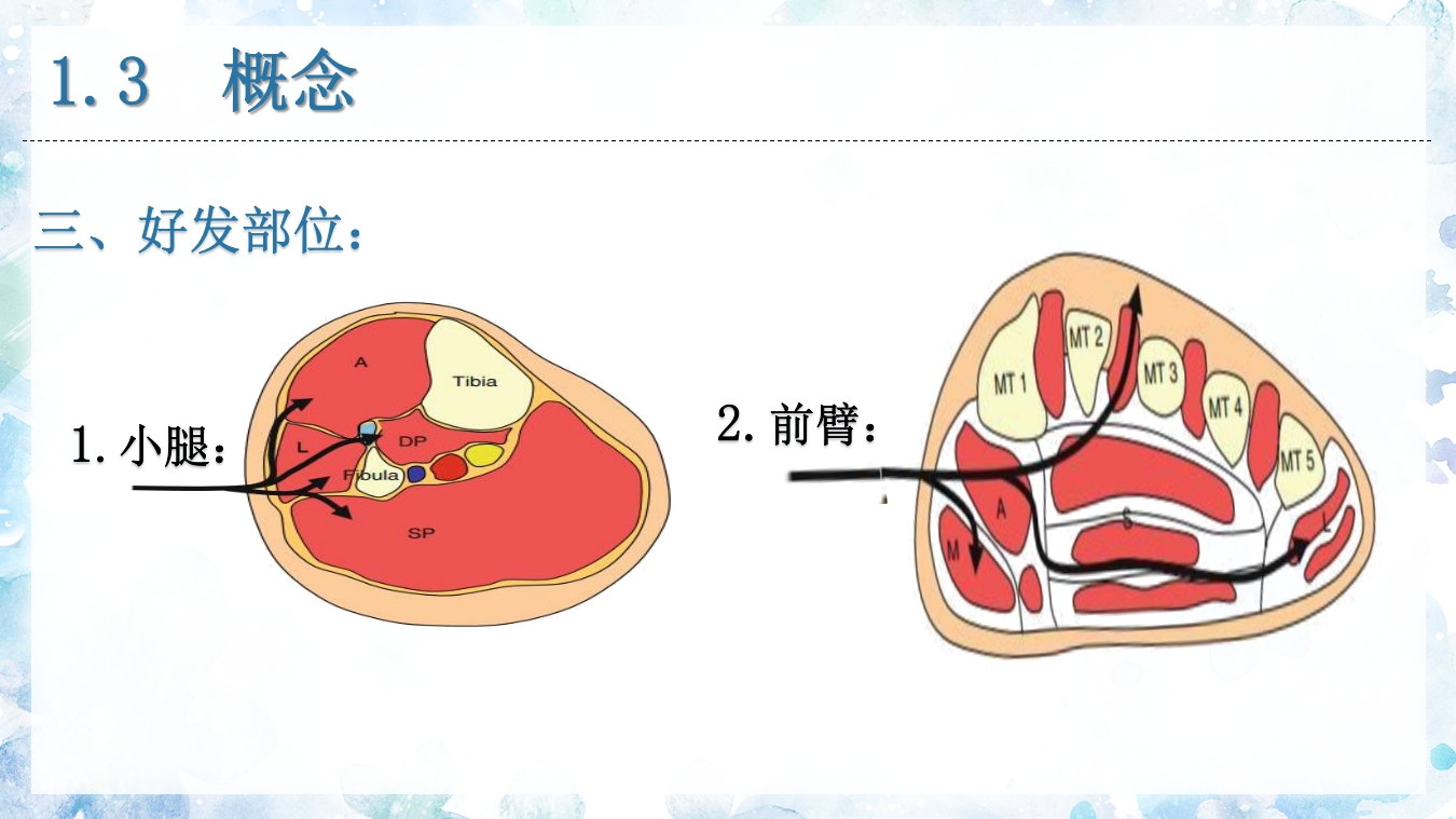 (骨筋膜室综合征)骨科小讲课PPT课件11