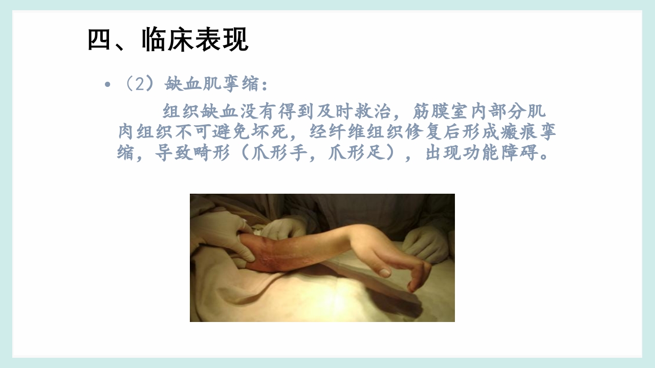 骨筋膜室综合征PPT课件15