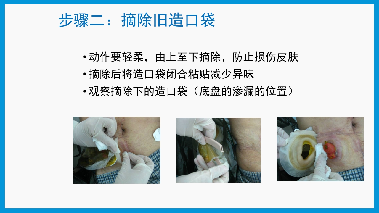 造口护理健康宣教PPT课件10