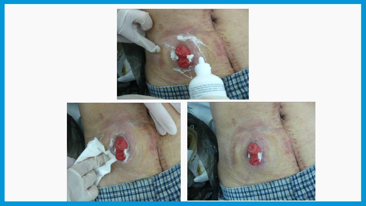 造口护理健康宣教PPT课件15