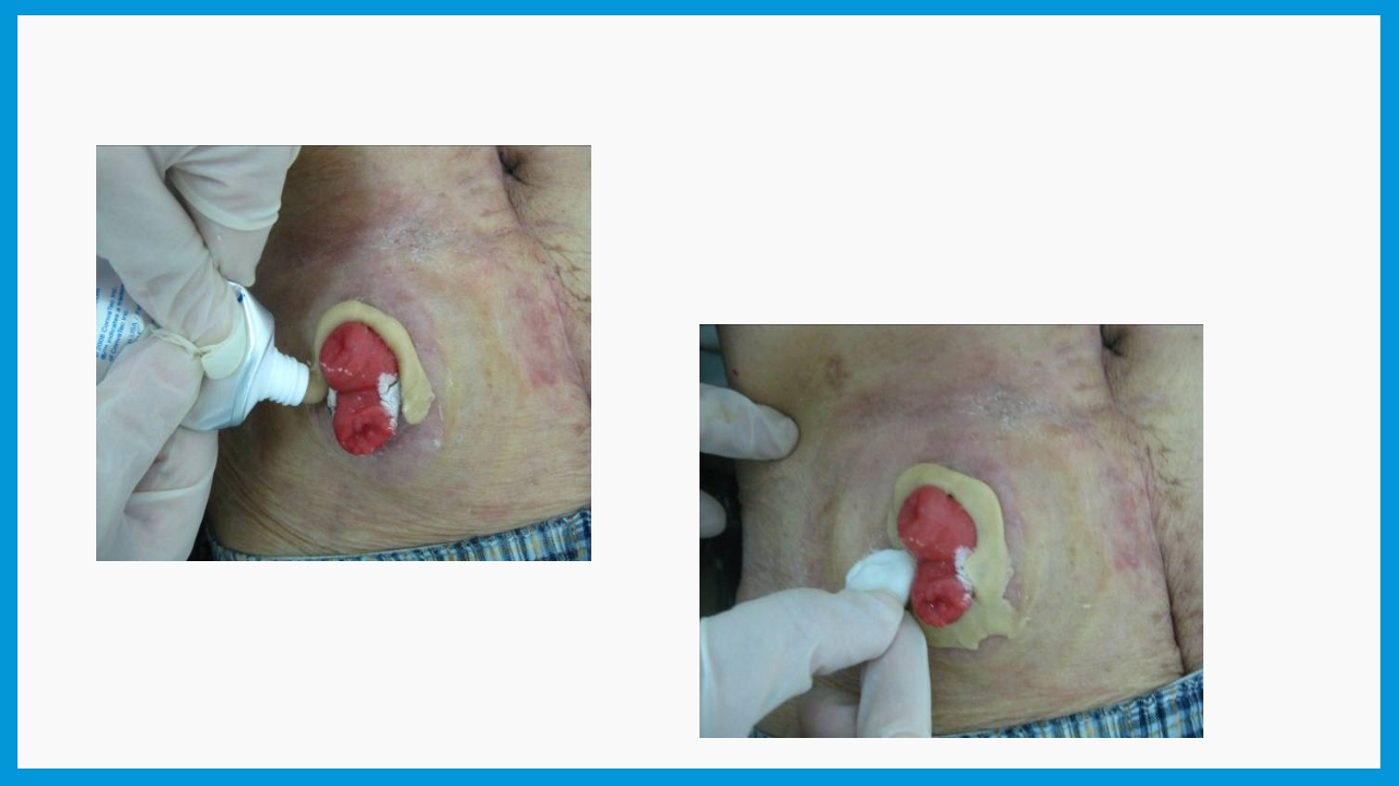 造口护理健康宣教PPT课件16