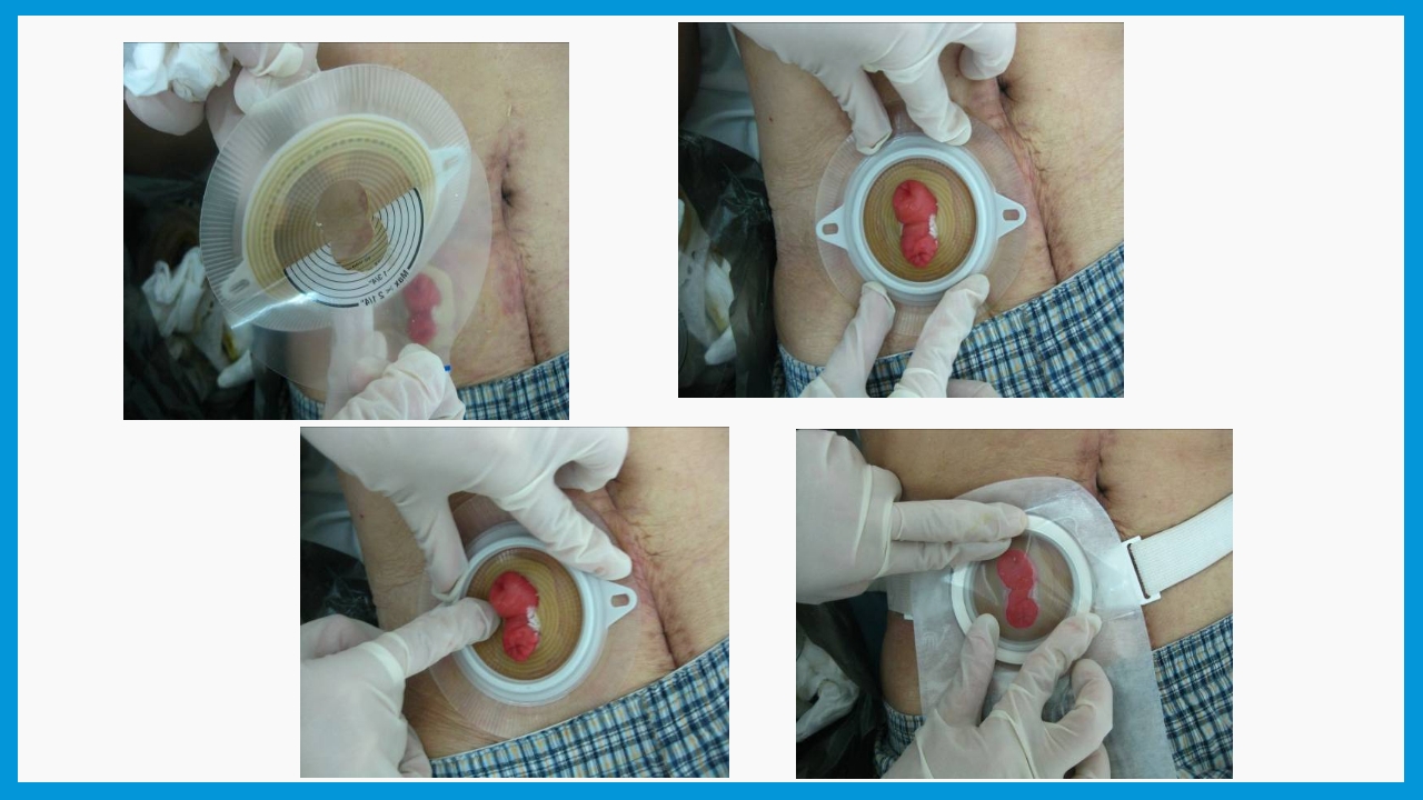造口护理健康宣教PPT课件17