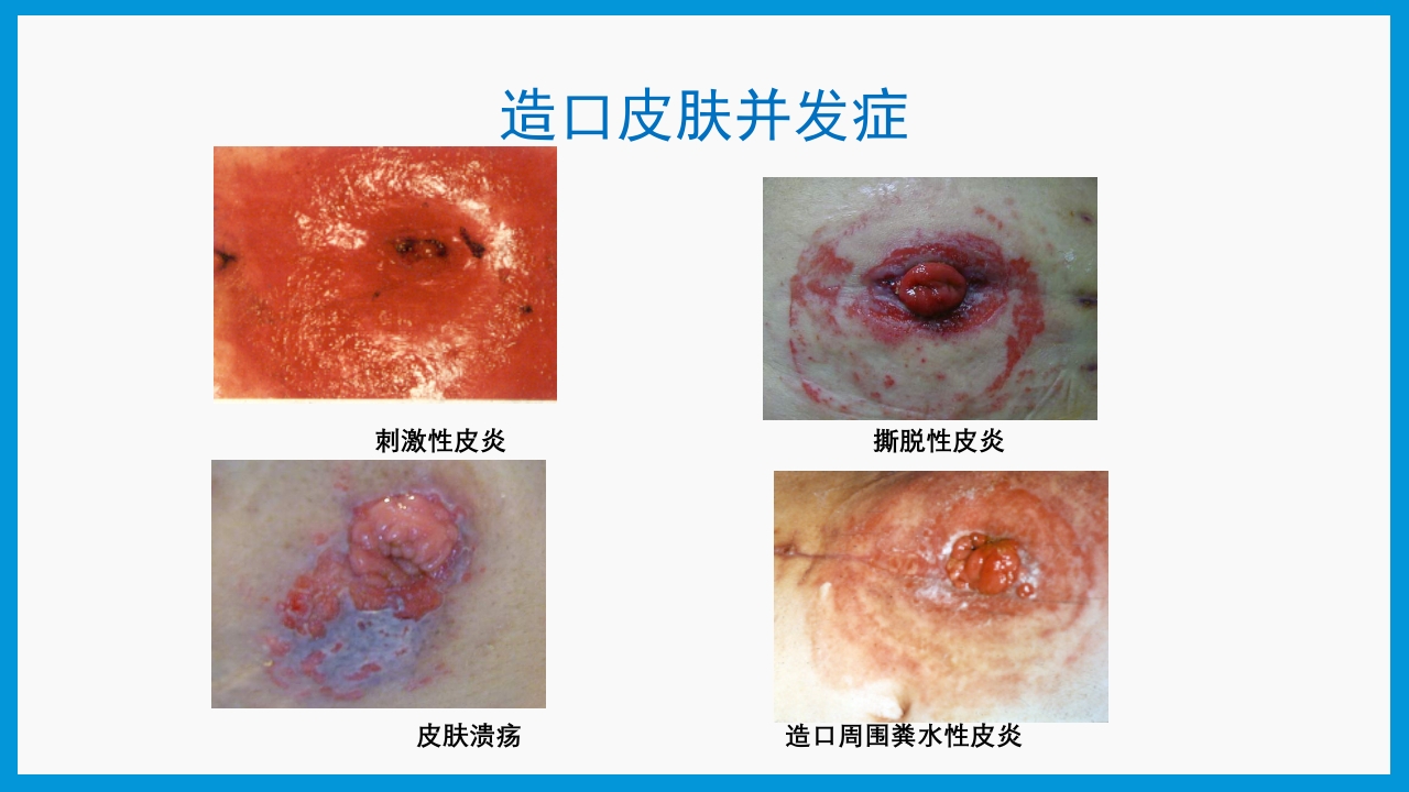 造口护理健康宣教PPT课件21