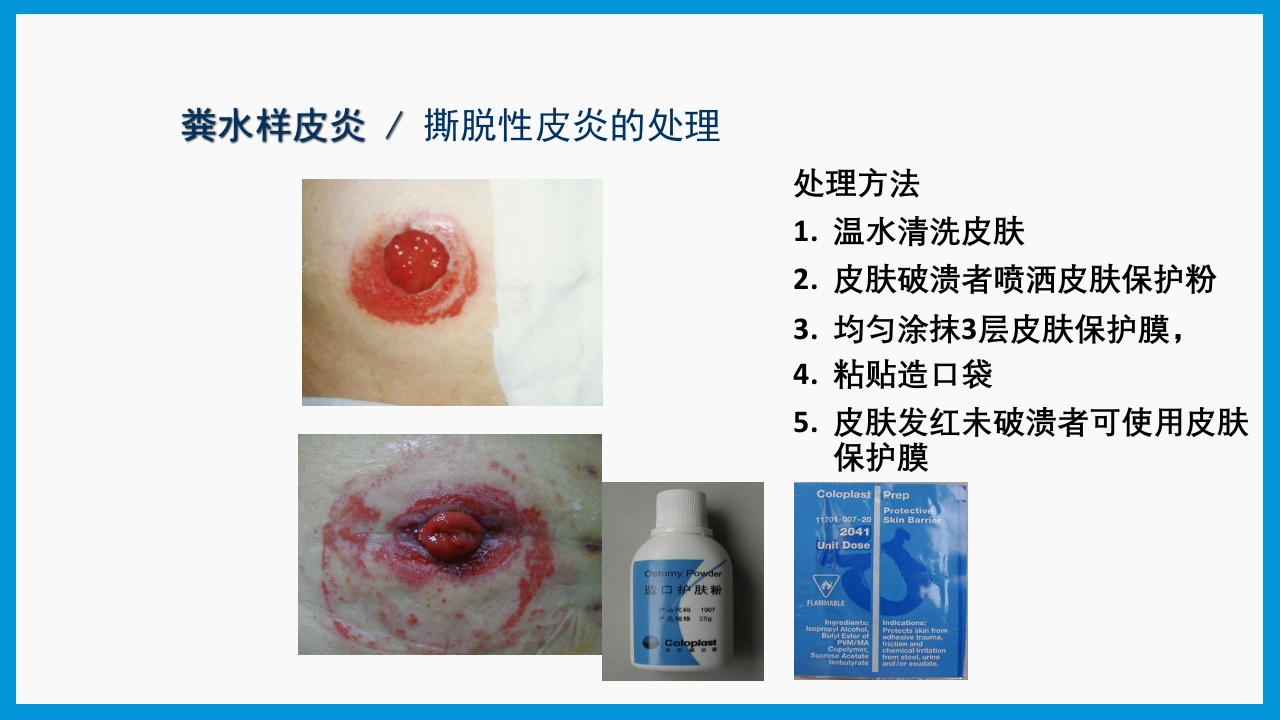 造口护理健康宣教PPT课件22