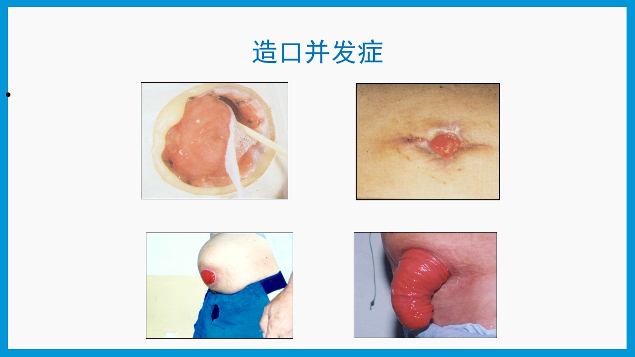 造口护理健康宣教PPT课件23