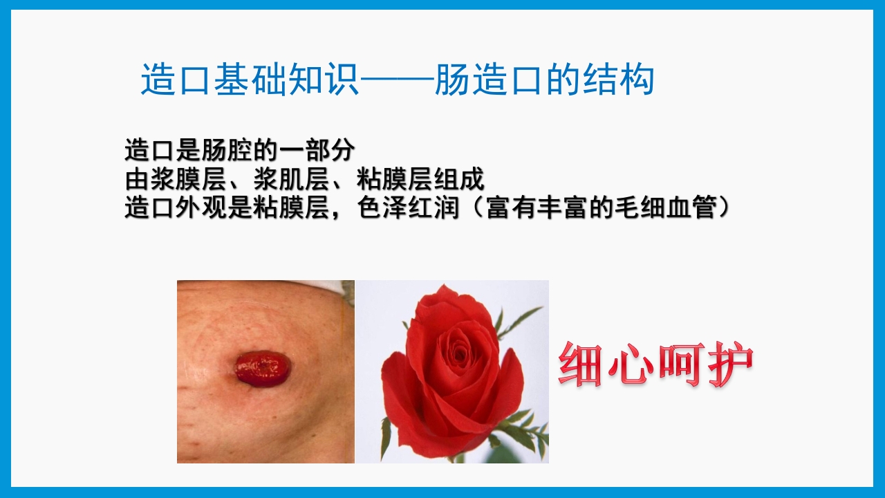 造口护理健康宣教PPT课件6