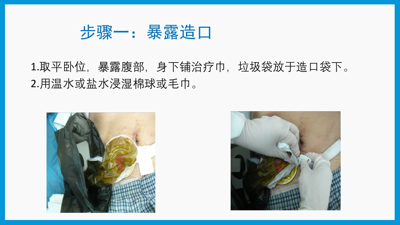 造口护理健康宣教PPT课件9