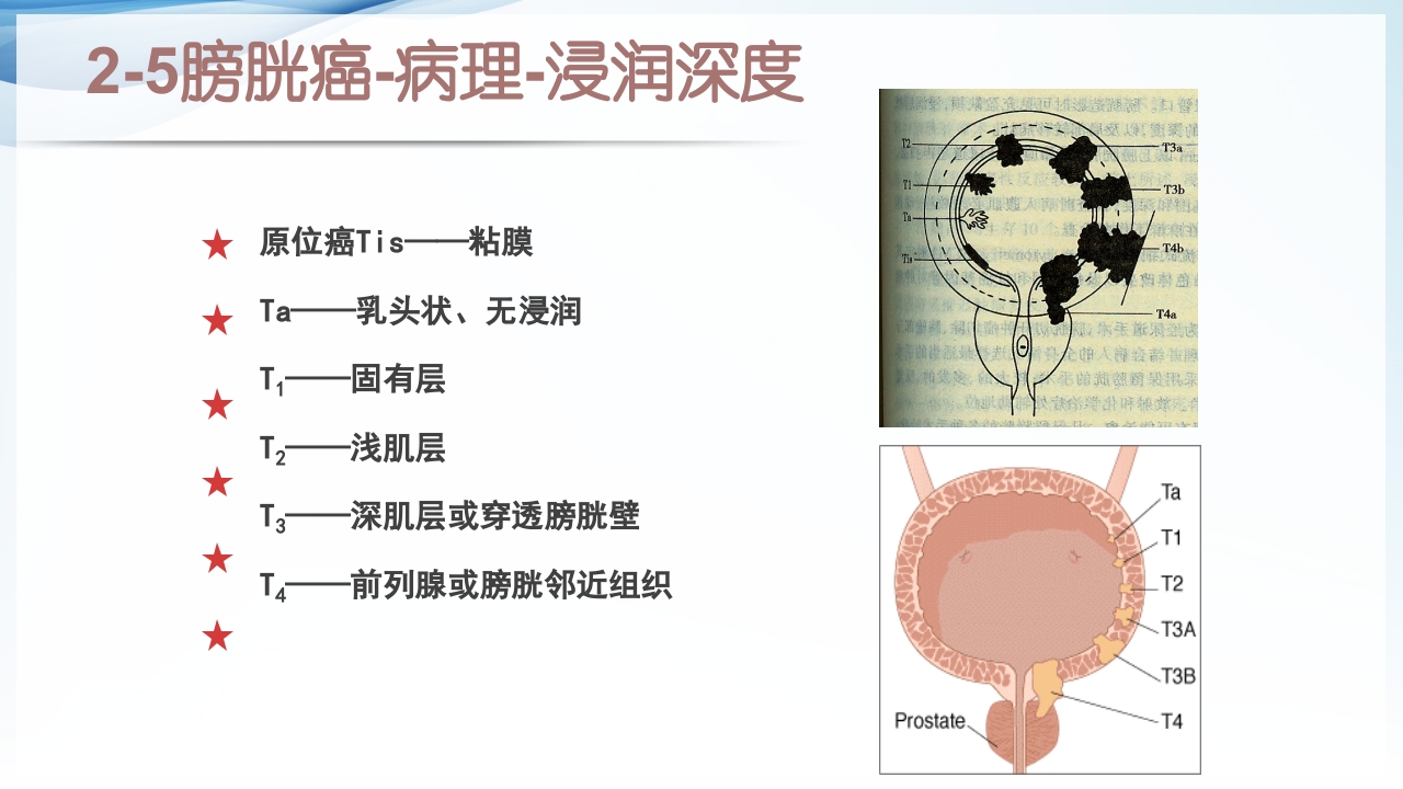 膀胱全切+回肠膀胱造口围手术期的护理查房ppt10