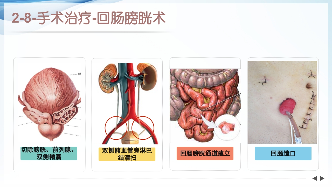 膀胱全切+回肠膀胱造口围手术期的护理查房ppt17