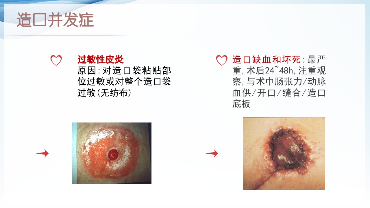 膀胱全切+回肠膀胱造口围手术期的护理查房ppt20