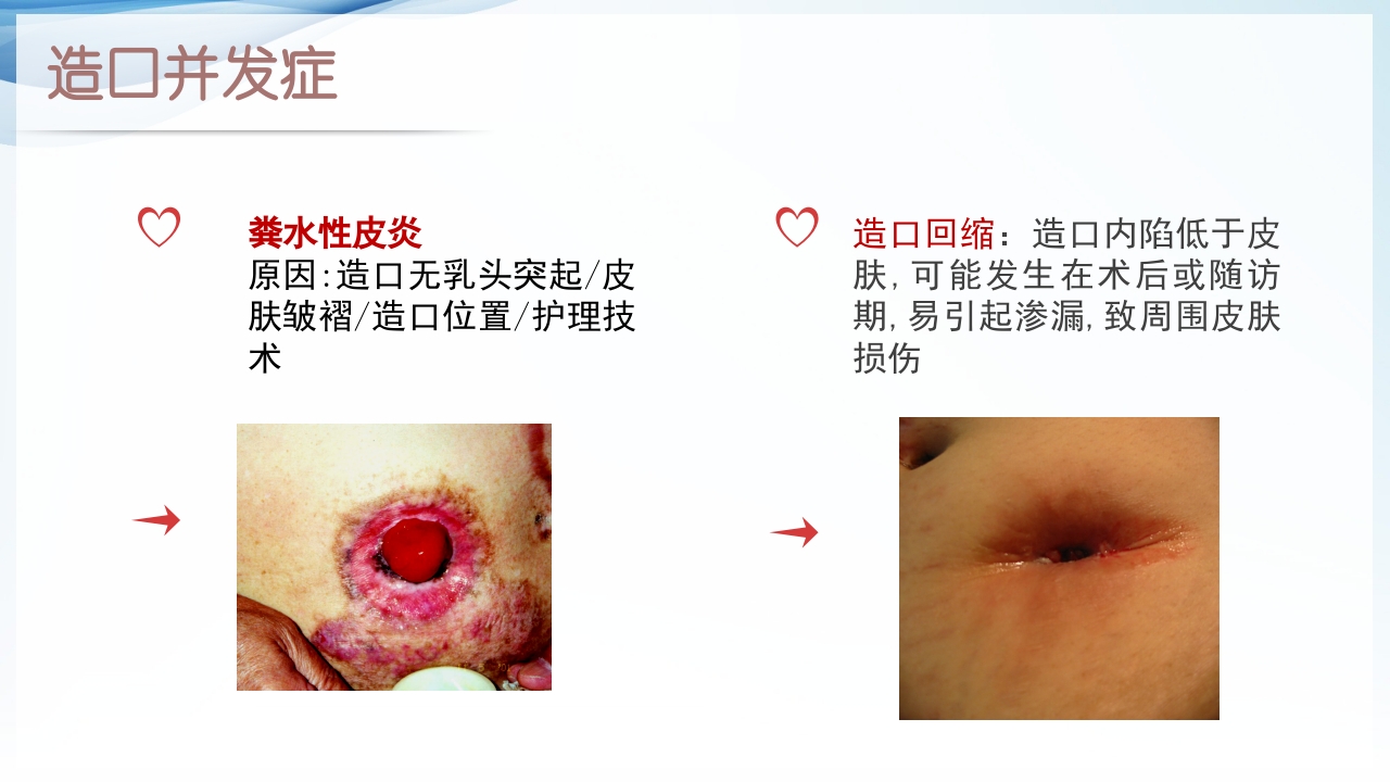 膀胱全切+回肠膀胱造口围手术期的护理查房ppt21