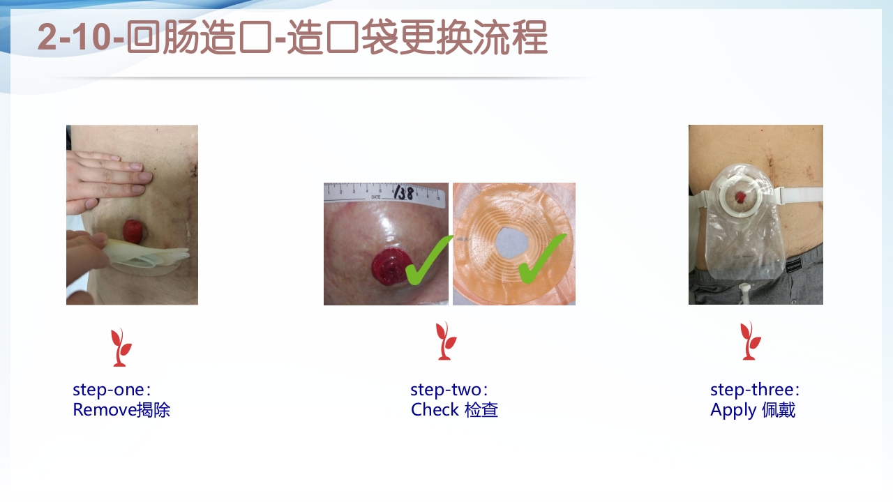 膀胱全切+回肠膀胱造口围手术期的护理查房ppt22