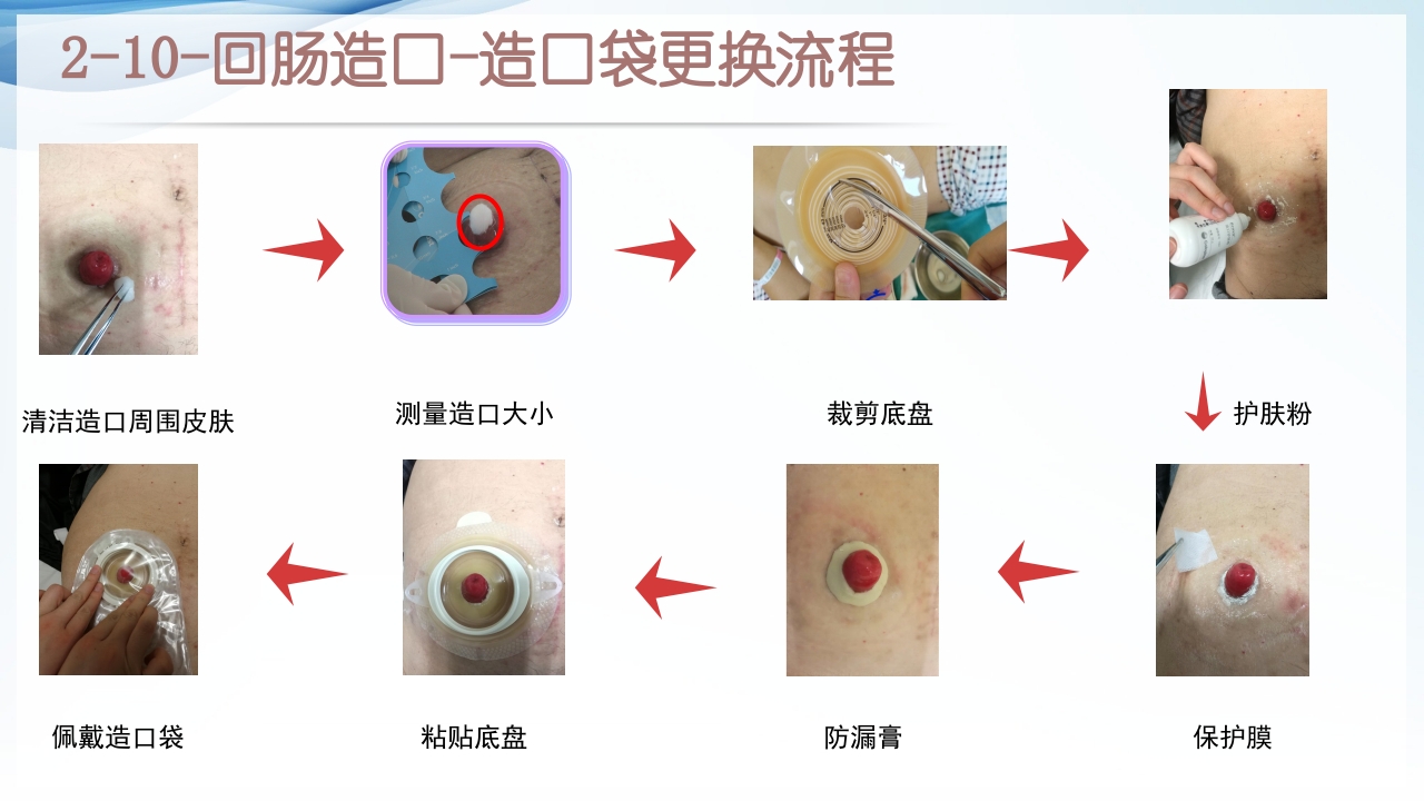 膀胱全切+回肠膀胱造口围手术期的护理查房ppt23