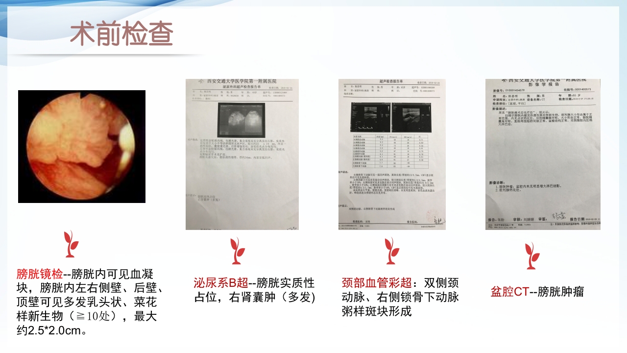 膀胱全切+回肠膀胱造口围手术期的护理查房ppt31