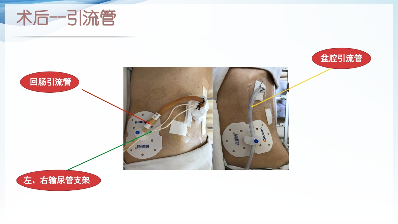 膀胱全切+回肠膀胱造口围手术期的护理查房ppt38