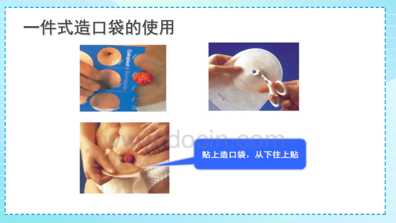 肠造口护理PPT课件16